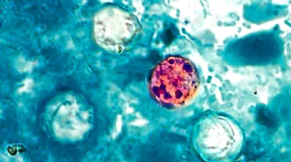 The Detection Puzzle: Why Cyclospora Outbreaks Are So Hard to Trace and Control
