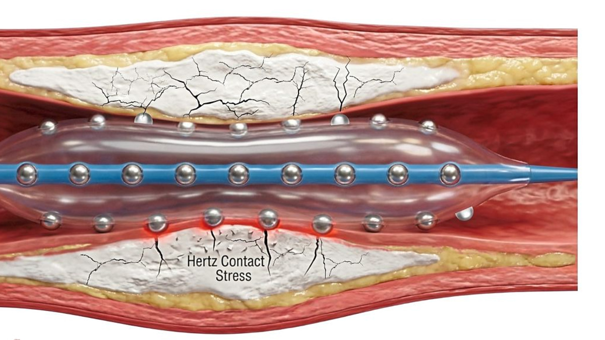 Malaysian doctors pioneer advanced technique to treat calcified heart artery blockages