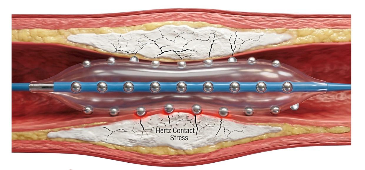 Malaysian doctors pioneer advanced technique to treat calcified heart artery blockages